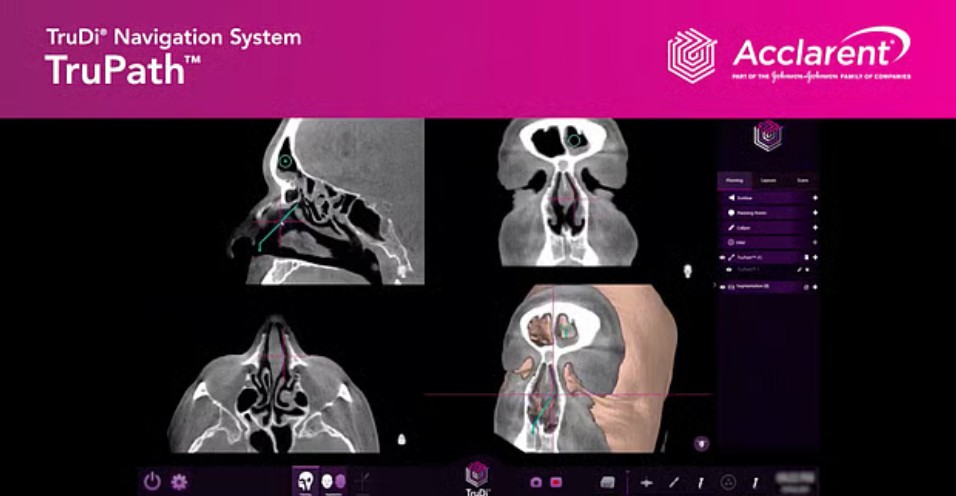 লিংকডইনে অ্যাক্লারেন্টের প্রকাশিত একটি ভিডিওতে তাদের ট্রুডি নেভিগেশন সিস্টেমের একটি এআই সুবিধা দেখানো হয়েছে। ‘ট্রুপাথ’ নামের এই ফিচার সার্জনদের দুটি নির্ধারিত বিন্দুর মধ্যে ‘সবচেয়ে সংক্ষিপ্ত ও কার্যকর পথ’ দেখায়ভিডিওর স্ক্রিনশট: রয়টার্স